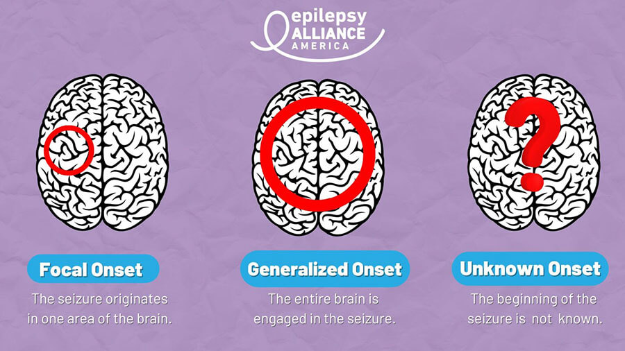 Onset of seizure